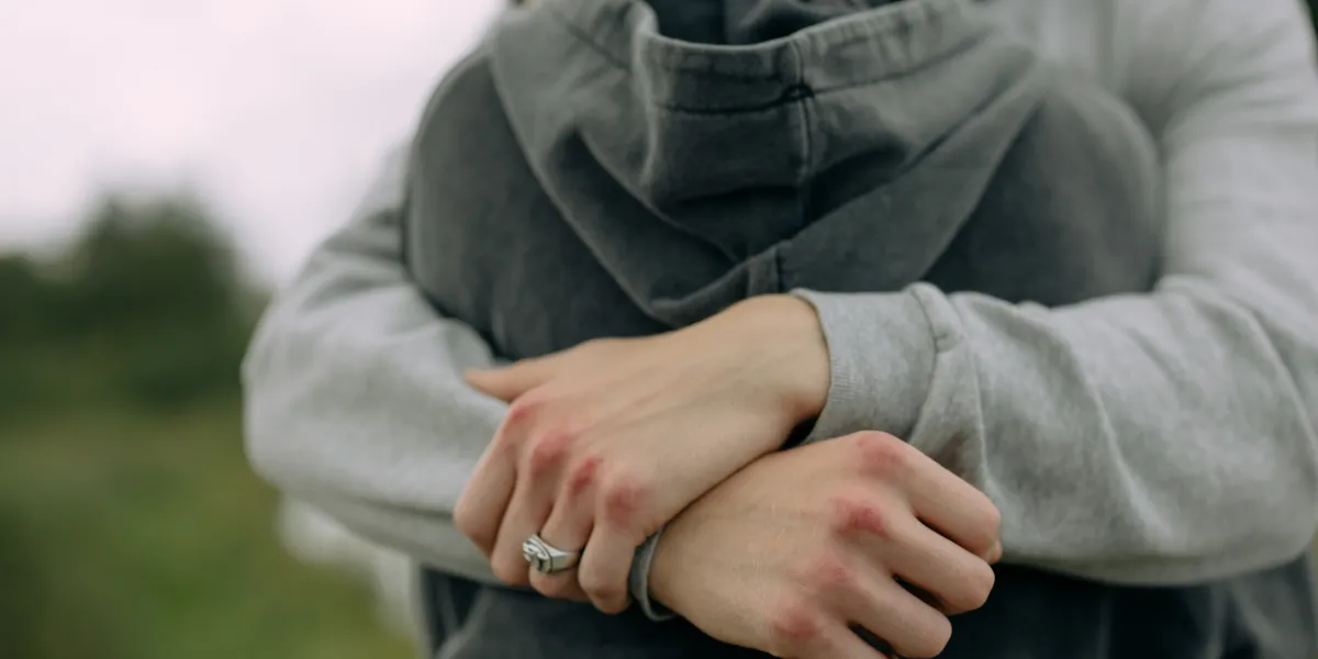 Person in a hoodie with arms crossed and bruised hands